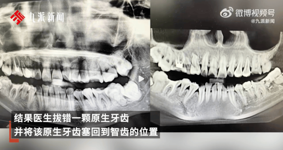 女子疑因拔错牙又被塞回坠楼身亡，多方回应